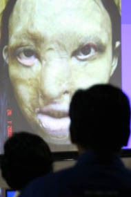 Tak Cuma Air Keras, Face Off Pun untuk Korban Serangan Anjing